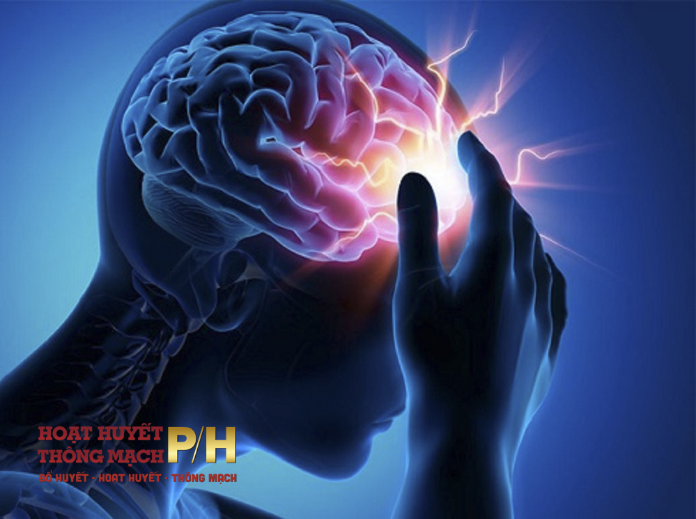 Rối loạn tuần hoàn não có thể dẫn tới đột quỵ?